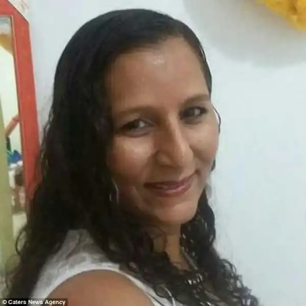 Unbelievable! Doctors Use Fish Skin to Treat Woman Who Suffered Severe Burns in Gas Explosion (Photos)
